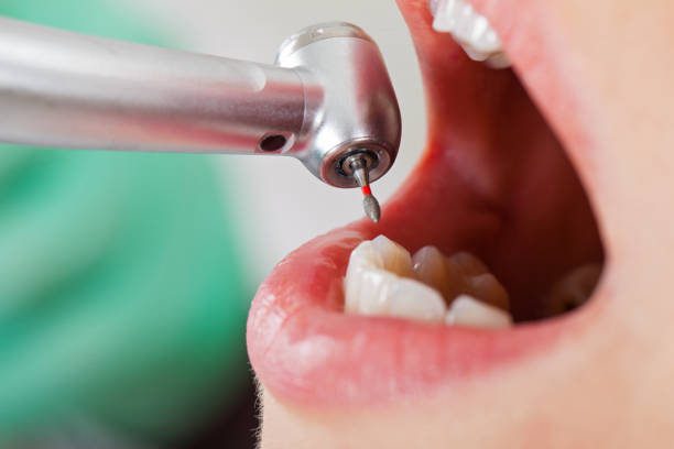 Best Urgent Tooth Repair  in Redkey, IN